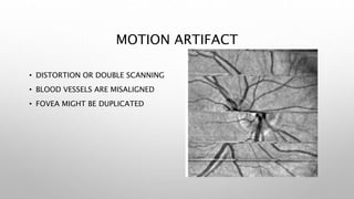 MOTION ARTIFACT
• DISTORTION OR DOUBLE SCANNING
• BLOOD VESSELS ARE MISALIGNED
• FOVEA MIGHT BE DUPLICATED
 