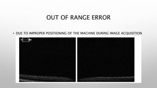 OUT OF RANGE ERROR
• DUE TO IMPROPER POSITIONING OF THE MACHINE DURING IMAGE ACQUISITION
 