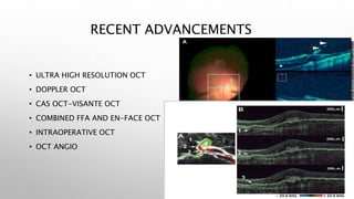RECENT ADVANCEMENTS
• ULTRA HIGH RESOLUTION OCT
• DOPPLER OCT
• CAS OCT-VISANTE OCT
• COMBINED FFA AND EN-FACE OCT
• INTRAOPERATIVE OCT
• OCT ANGIO
 