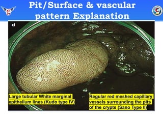 Optical diagnosis of colorectal neoplasia. GastroMilitary 2021. https ...