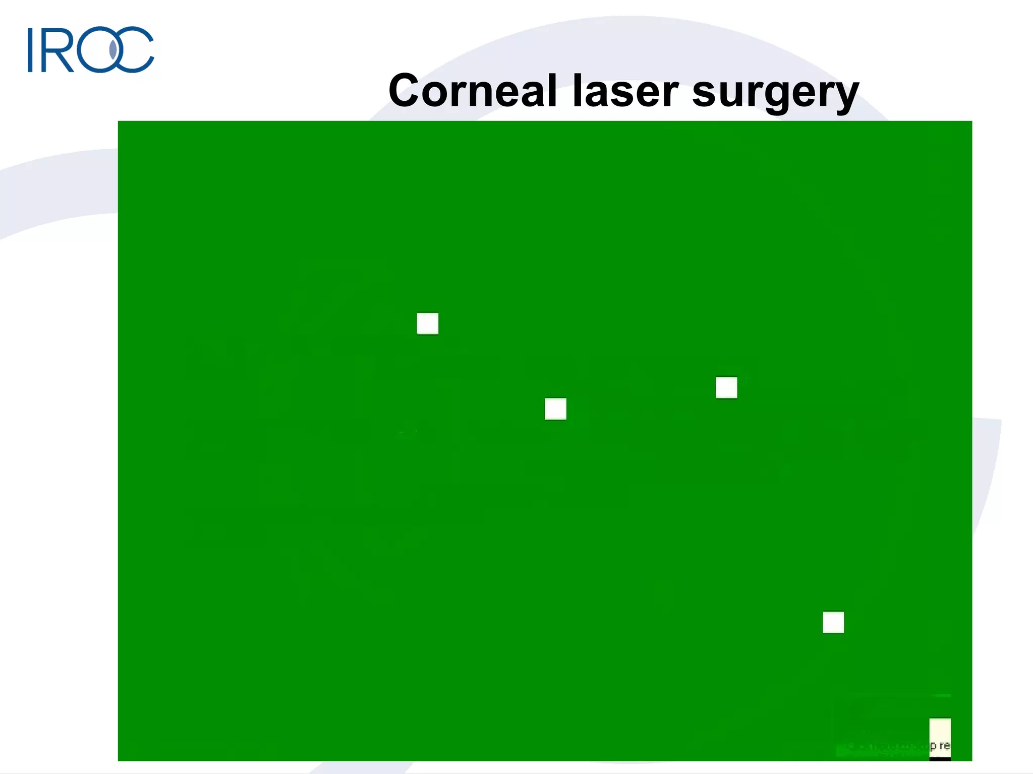 Corneal laser surgery 