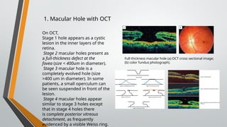 Optical coherence tomography (OCT) retinal examination.pptx