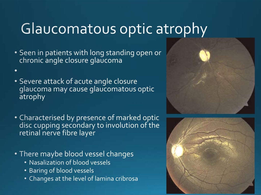 Optic atrophy