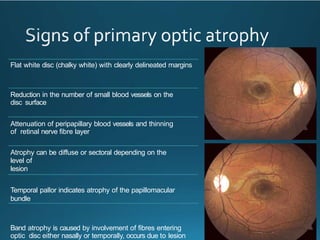 Comprehensive Overview of Optic Atrophy: Types, Causes, and Diagnosis ...
