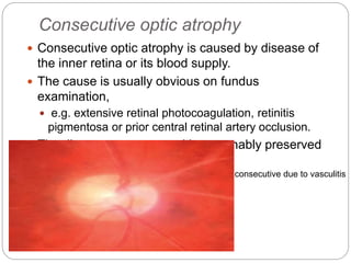 Consecutive optic atrophy
 Consecutive optic atrophy is caused by disease of
the inner retina or its blood supply.
 The cause is usually obvious on fundus
examination,
 e.g. extensive retinal photocoagulation, retinitis
pigmentosa or prior central retinal artery occlusion.
 The disc appears waxy, with reasonably preserved
architecture
consecutive due to vasculitis
 