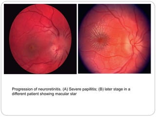 Progression of neuroretinitis. (A) Severe papillitis; (B) later stage in a
different patient showing macular star
 