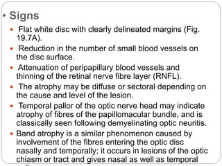 • Signs
 Flat white disc with clearly delineated margins (Fig.
19.7A).
 Reduction in the number of small blood vessels on
the disc surface.
 Attenuation of peripapillary blood vessels and
thinning of the retinal nerve fibre layer (RNFL).
 The atrophy may be diffuse or sectoral depending on
the cause and level of the lesion.
 Temporal pallor of the optic nerve head may indicate
atrophy of fibres of the papillomacular bundle, and is
classically seen following demyelinating optic neuritis.
 Band atrophy is a similar phenomenon caused by
involvement of the fibres entering the optic disc
nasally and temporally; it occurs in lesions of the optic
chiasm or tract and gives nasal as well as temporal
 