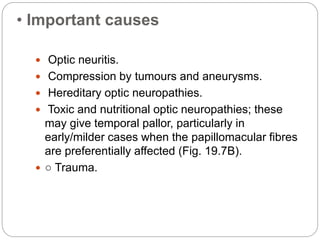 • Important causes
 Optic neuritis.
 Compression by tumours and aneurysms.
 Hereditary optic neuropathies.
 Toxic and nutritional optic neuropathies; these
may give temporal pallor, particularly in
early/milder cases when the papillomacular fibres
are preferentially affected (Fig. 19.7B).
 ○ Trauma.
 