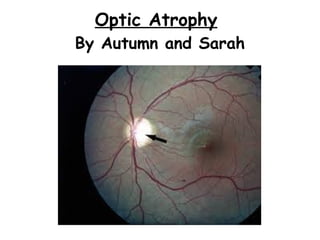 Optic Atrophy
By Autumn and Sarah

 