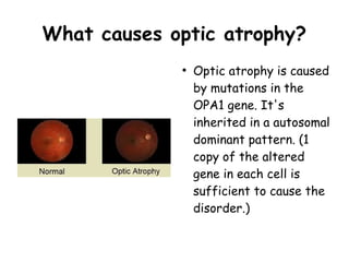 What causes optic atrophy?
●
Optic atrophy is caused
by mutations in the
OPA1 gene. It's
inherited in a autosomal
dominant pattern. (1
copy of the altered
gene in each cell is
sufficient to cause the
disorder.)