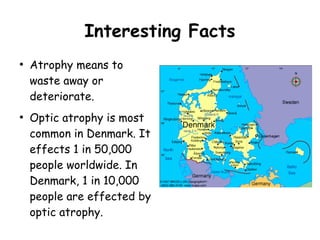 Interesting Facts
●
●
Atrophy means to
waste away or
deteriorate.
Optic atrophy is most
common in Denmark. It
effects 1 in 50,000
people worldwide. In
Denmark, 1 in 10,000
people are effected by
optic atrophy.
