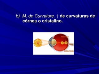 bb) M. de Curvature.) M. de Curvature. ↑↑ de curvaturas dede curvaturas de
córnea o cristalino.córnea o cristalino.
 