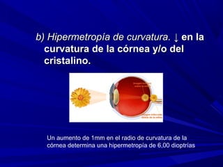 b) Hipermetropía de curvatura.b) Hipermetropía de curvatura. ↓↓ en laen la
curvatura de la córnea y/o delcurvatura de la córnea y/o del
cristalino.cristalino.
Un aumento de 1mm en el radio de curvatura de la
córnea determina una hipermetropía de 6,00 dioptrías
 