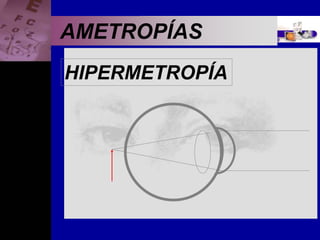 Enfermedades Oculares
AMETROPÍAS
HIPERMETROPÍA
 