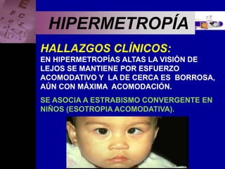 Enfermedades Oculares
HIPERMETROPÍA
HALLAZGOS CLÍNICOS:
EN HIPERMETROPÍAS ALTAS LA VISIÓN DE
LEJOS SE MANTIENE POR ESFUERZO
ACOMODATIVO Y LA DE CERCA ES BORROSA,
AÚN CON MÁXIMA ACOMODACIÓN.
SE ASOCIA A ESTRABISMO CONVERGENTE EN
NIÑOS (ESOTROPIA ACOMODATIVA).
 