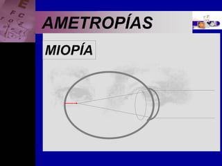 Enfermedades Oculares
AMETROPÍAS
MIOPÍA
 