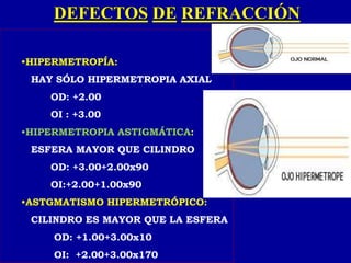 DEFECTOS DE REFRACCIÓN
•HIPERMETROPÍA:
HAY SÓLO HIPERMETROPIA AXIAL
OD: +2.00
OI : +3.00
•HIPERMETROPIA ASTIGMÁTICA:
ESFERA MAYOR QUE CILINDRO
OD: +3.00+2.00x90
OI:+2.00+1.00x90
•ASTGMATISMO HIPERMETRÓPICO:
CILINDRO ES MAYOR QUE LA ESFERA
OD: +1.00+3.00x10
OI: +2.00+3.00x170
 