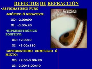 DEFECTOS DE REFRACCIÓN
•ASTIGMATISMO PURO
•MIÓPICO Ó NEGATIVO:
OD: -2.00x90
OI: -3.00x90
•HIPERMETRÓPICO Ó
POSITIVO:
OD: +2.00x0
OI: +3.00x180
•ASTIGMATISMO COMPLEJO Ó
MIXTO:
OD: +2.00-3.00x20
OI: -2.00+5.00x40
 