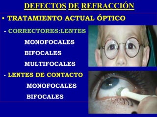 DEFECTOS DE REFRACCIÓN
• TRATAMIENTO ACTUAL ÓPTICO
- CORRECTORES:LENTES
MONOFOCALES
BIFOCALES
MULTIFOCALES
- LENTES DE CONTACTO
MONOFOCALES
BIFOCALES
 