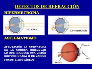 DEFECTOS DE REFRACCIÓN
HIPERMETROPÍA
ASTIGMATISMO
AFECTACIÓN LA CURVATURA
DE LA CORNEA IRREGULAR
LO QUE PRODUCE UNA VISIÓN
DISTORSIONADA O DE VARIOS
FOCOS SIMULTÁNEOS.
 