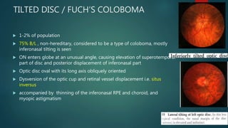 TILTED DISC / FUCH’S COLOBOMA
 1-2% of population
 75% B/L , non-hereditary, considered to be a type of coloboma, mostly
inferonasal tilting is seen
 ON enters globe at an unusual angle, causing elevation of superotemporal
part of disc and posterior displacement of inferonasal part
 Optic disc oval with its long axis obliquely oriented
 Dysversion of the optic cup and retinal vessel displacement i.e. situs
inversus
 accompanied by thinning of the inferonasal RPE and choroid, and
myopic astigmatism
 