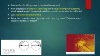  Greater the disc tilting, more is the visual impairment
 Non-progressive Bitemporal Hemianopia in the superotemporal quadrants
which donot respect the vertical meridians, mostly medium isopters affected
 D/d: suprasellar chiasmal tumors
 Refractive correction has a high chance of correcting these VF defects unless
associated ectasia is present
 