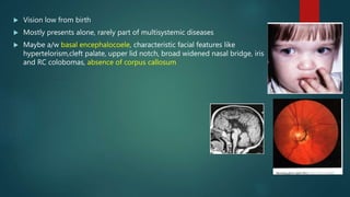 Vision low from birth
 Mostly presents alone, rarely part of multisystemic diseases
 Maybe a/w basal encephalocoele, characteristic facial features like
hypertelorism,cleft palate, upper lid notch, broad widened nasal bridge, iris
and RC colobomas, absence of corpus callosum
 