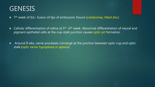 GENESIS
 7th week of IUL- fusion of lips of embryonic fissure (colobomas, tilted disc)
 Cellular differentiation of retina at 5th -6th week. Abnormal differentiation of neural and
pigment epithelial cells at the cup-stalk junction causes optic pit formation
 Around 8 wks, nerve processes converge at the junction between optic cup and optic
stalk.(optic nerve hypoplasia or aplasia)
 