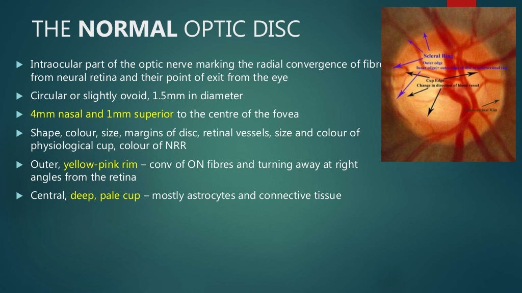 CONGENITAL OPTIC DISC ANOMALIES