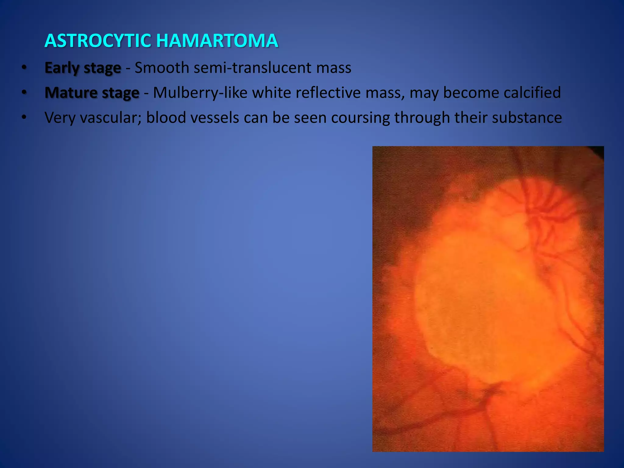 Optic disc evaluation | PPTX