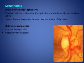 Optic Disc Compression Optic disc evaluation | PPTX