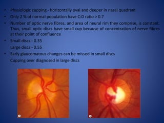 Disc At Risk Optic disc evaluation | PPTX
