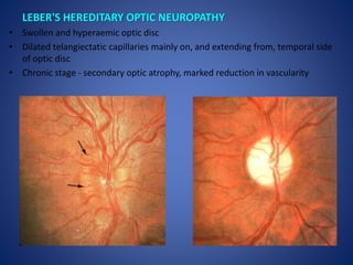 OPTIC ATROPHY
PRIMARY OPTIC ATROPHY
• Chalky white optic disc with clearly defined margins
• Disc pallor, more on temporal...