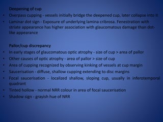 Advanced glaucomatous cupping
• Total cupping - white disc with loss of all neural rim tissue
• Bending of vessels at disc...