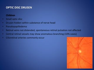 Adolescents and adults
• Drusen - single or multiple, glistening, semi-translucent; may coalesce – give
disc a yellow-pink...