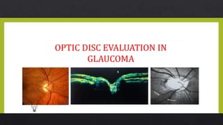 OPTIC DISC EVALUATION IN
GLAUCOMA
 