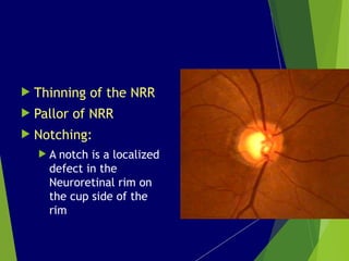Notching Helical Rim Comprehensive Optic Disc Assessment for Glaucoma Diagnosis and ...