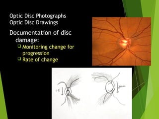Optic Disc Compression Comprehensive Optic Disc Assessment for Glaucoma Diagnosis and ...