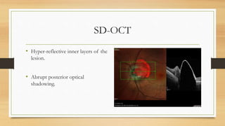 SD-OCT
• Hyper-reflective inner layers of the
lesion.
• Abrupt posterior optical
shadowing.
 