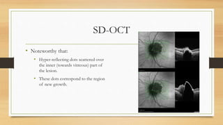 SD-OCT
• Noteworthy that:
• Hyper-reflecting dots scattered over
the inner (towards vitreous) part of
the lesion.
• These dots correspond to the region
of new growth.
 