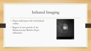 Infrared Imaging
• Hyper-reflectance with well defined
outline
• Region of new growth of the
Melanocytoma: Relative Hypo-
reflectance
 