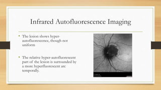 Infrared Autofluorescence Imaging
• The lesion shows hyper-
autofluorescence, though not
uniform
• The relative hyper-autofluorescent
part of the lesion is surrounded by
a more hyperfluorescent arc
temporally.
 