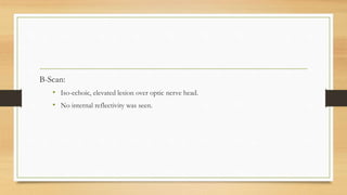 B-Scan:
• Iso-echoic, elevated lesion over optic nerve head.
• No internal reflectivity was seen.
 