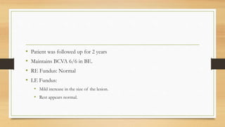 • Patient was followed up for 2 years
• Maintains BCVA 6/6 in BE.
• RE Fundus: Normal
• LE Fundus:
• Mild increase in the size of the lesion.
• Rest appears normal.
 