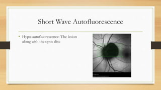Short Wave Autofluorescence
• Hypo-autofluorescence: The lesion
along with the optic disc
 