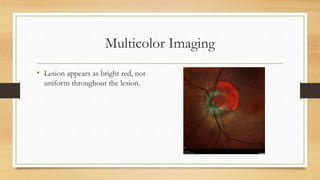 Multicolor Imaging
• Lesion appears as bright red, not
uniform throughout the lesion.
 