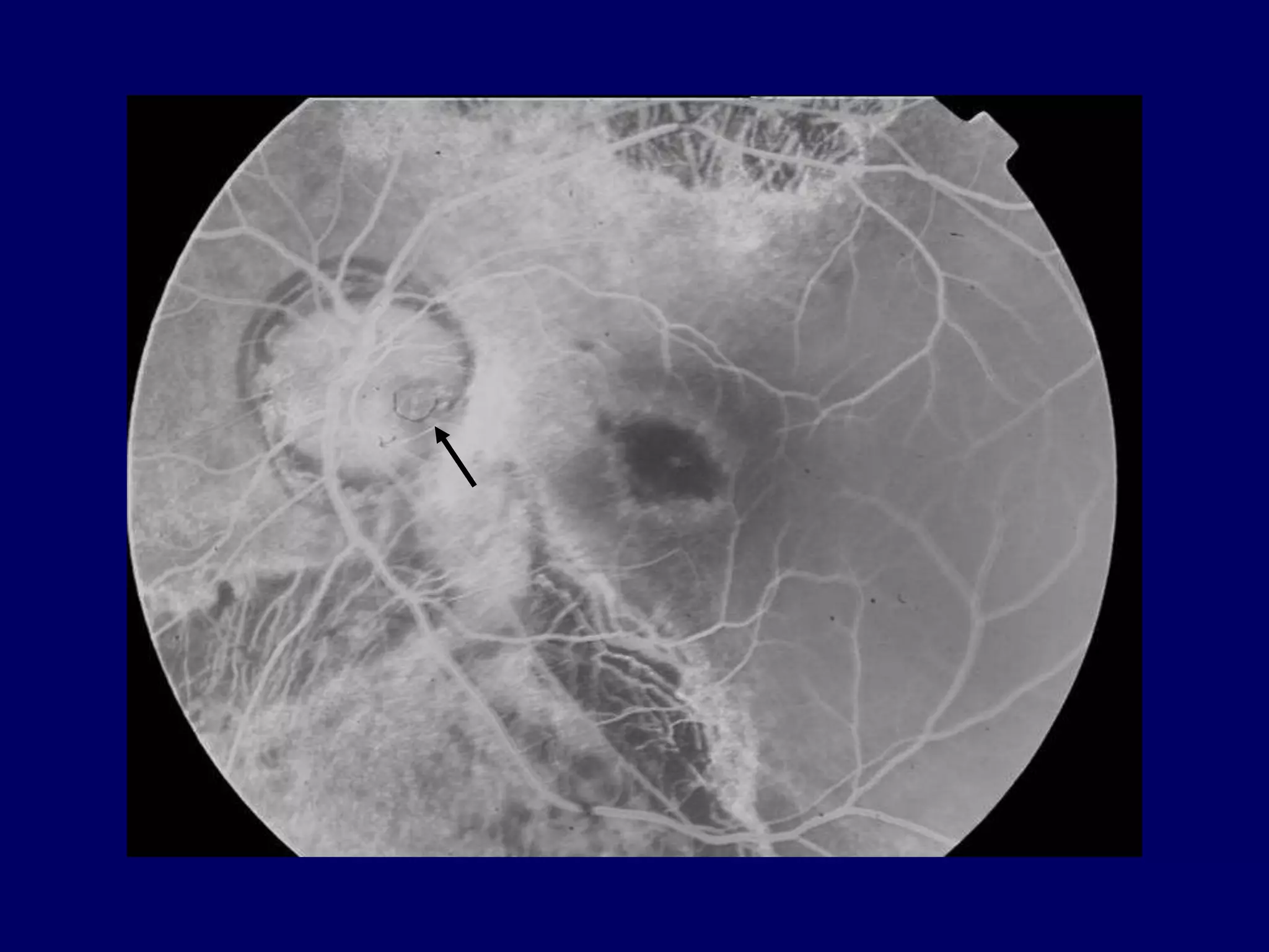 Optic disc pit pathogenesis and management ppt
