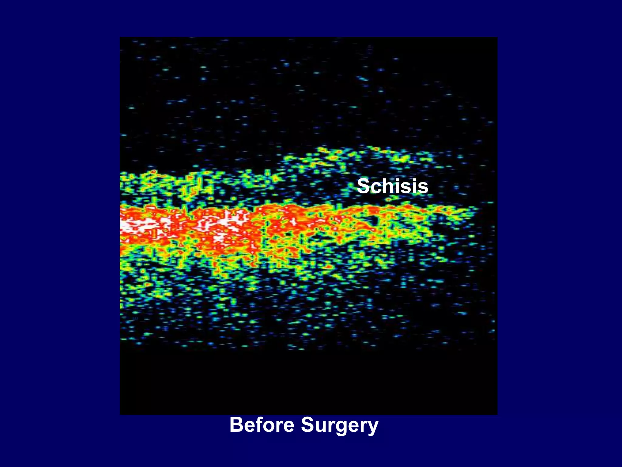 Optic disc pit pathogenesis and management ppt
