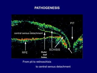 From pit to retinoschisis
to central serous detachment
Outer
leaf
holes
central serous detachment
PATHOGENESIS
 