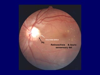 Pit
Choroidal defect
Retinoschisis & neuro-
sensensory det
 